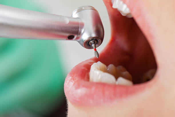 Best Emergency Treatment for Dental Infections or Abscesses in Bartonville, TX